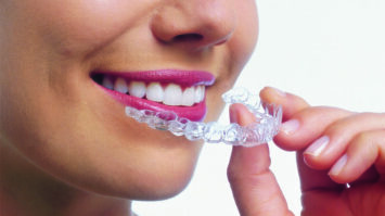 Invisalign